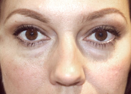 before and after of woman receiving restylane injections