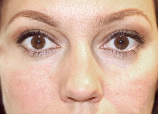 restylane injection results to the upper face