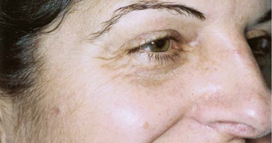 laser skin resurfacing treatment around the eyes