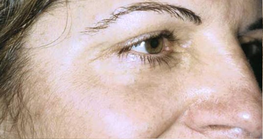Laser Skin resurfacing procedure on female patient