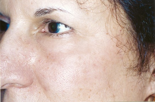 laser skin resurfacing results on female patient