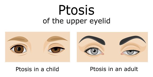 Ptosis of upper eyelid in child and adult diagram
