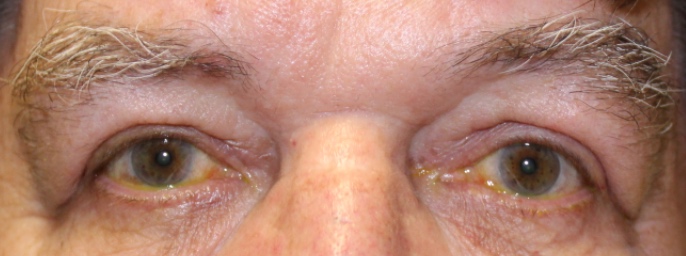 male after blepharoplasty eye surgery