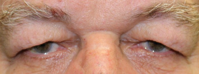 male before upper blepharoplasty eye procedure