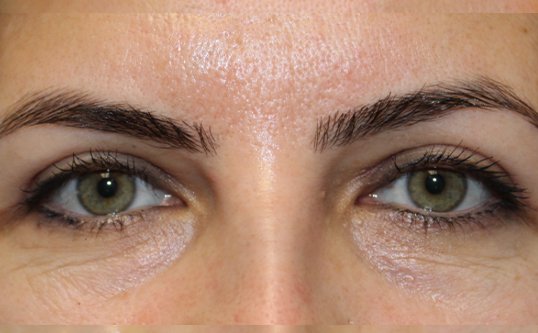 woman after blepharoplasty on the lower eye