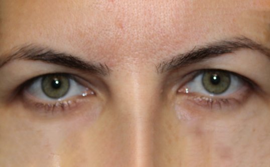 woman before blepharoplasty on the upper eye