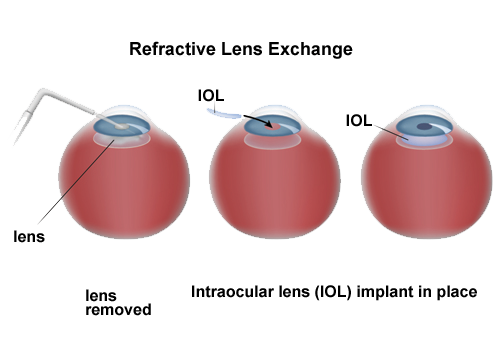 refractive lens exchange diagram