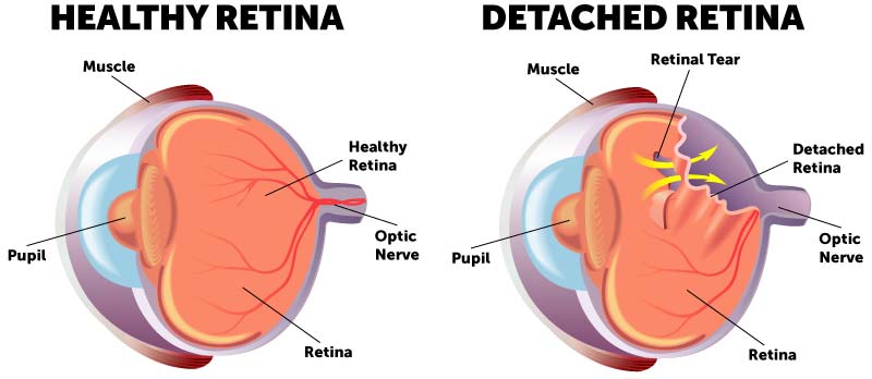 healthy eye compared to detached retina diagram