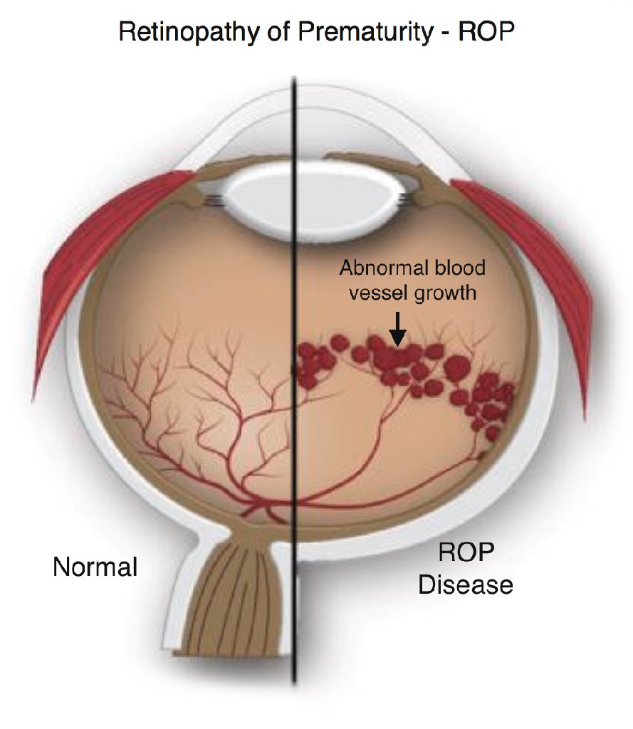 Normal eye compared to retinopathy of prematurity