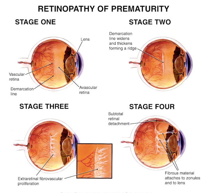 stages of retinopathy diagram