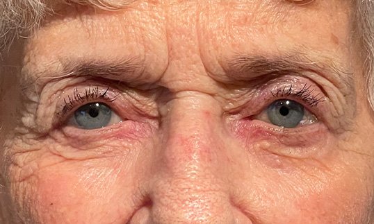 female eyes before ptosis repair