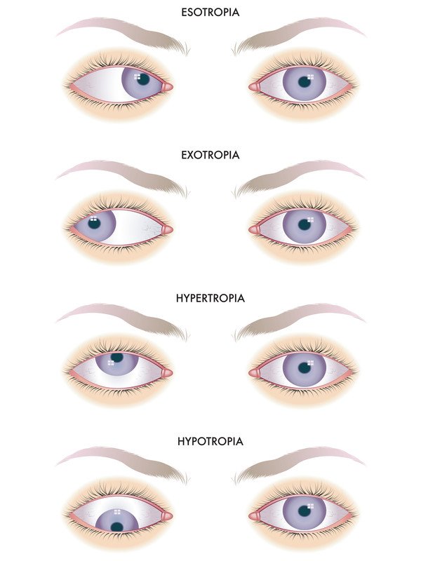 strabismus type diagram