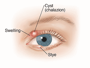 Illustration of a stye and chalazion cyst on the eyelid
