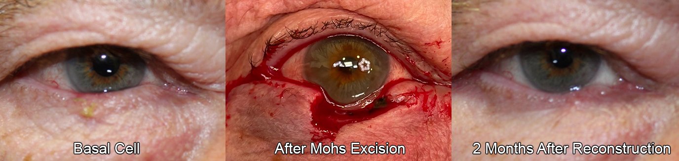Before, after, and recovery from MOHS excision