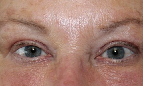 woman after blepharoplasty eye surgery