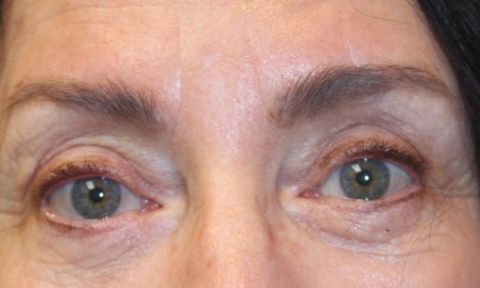female with blue eyes front facing after upper blepharoplasty