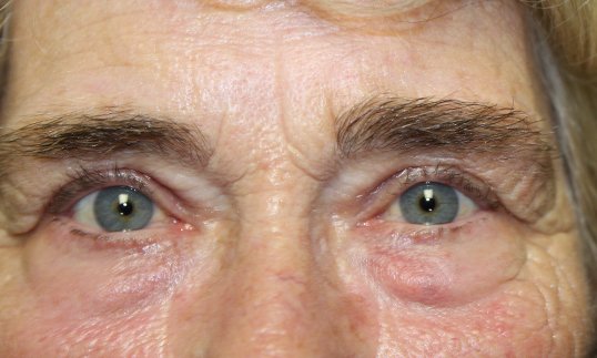 after blepharoplasty procedure on male patient