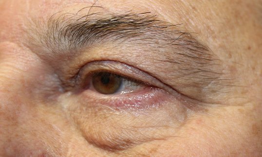 close up of eye after blepharoplasty
