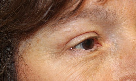 close up of female eye after blepharoplasty