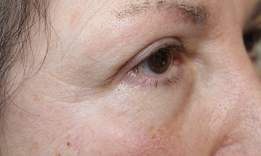 patient results for blepharoplasty female