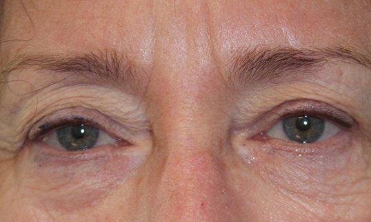 upper blepharoplasty before on male patient