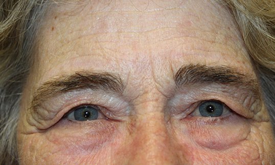 both eyes upper blepharoplasty before