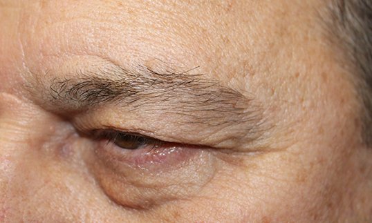 right eye before a blepharoplasty procedure