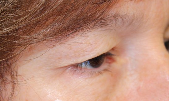 blepharoplasty surgery before over the left eye