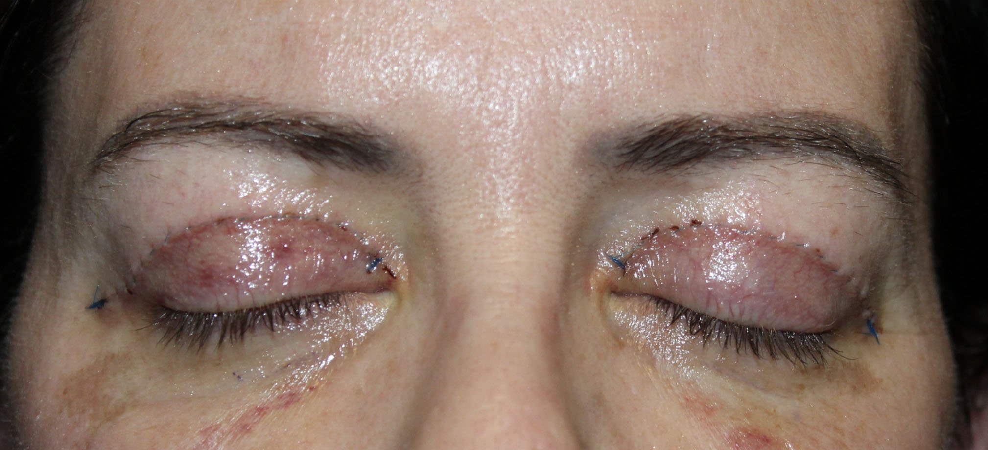 woman eyes closed upper blepharoplasty procedure