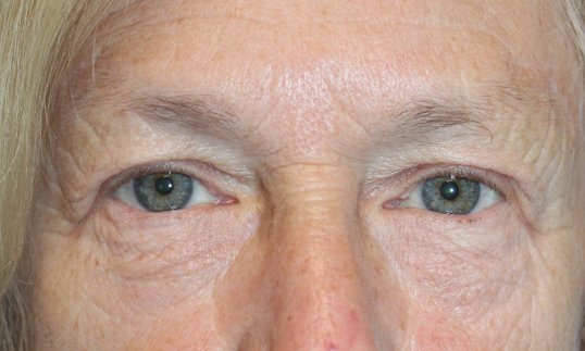 upper blepharoplasty and brow lift on female patient results