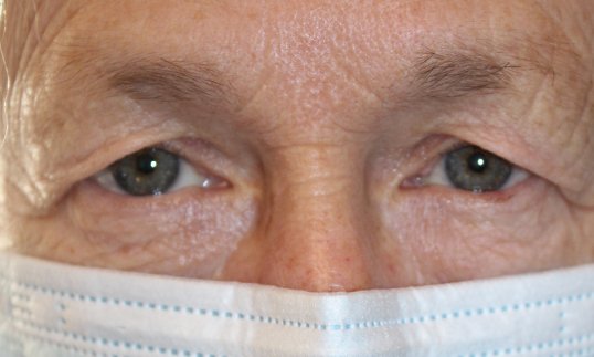upper blepharoplasty and browlift on male patient before the surgery