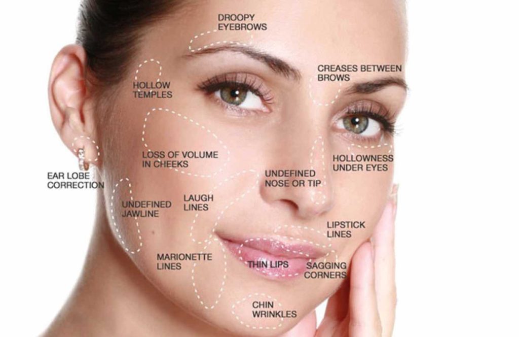 diagram of the areas of the face that can be targeted with a vampire facelift