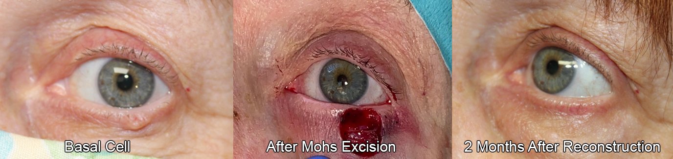 before and after with recovery 2 months later of MOHS excision