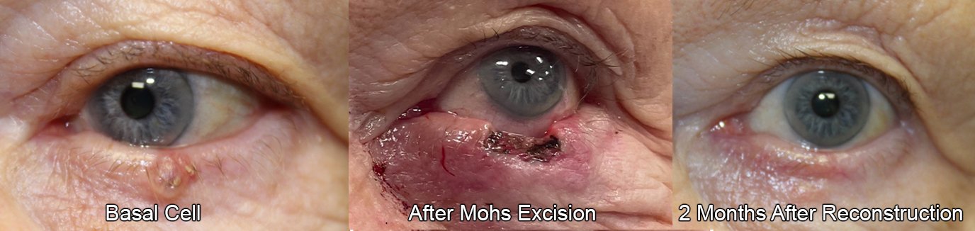before and after basal cell removal on lower eyelid