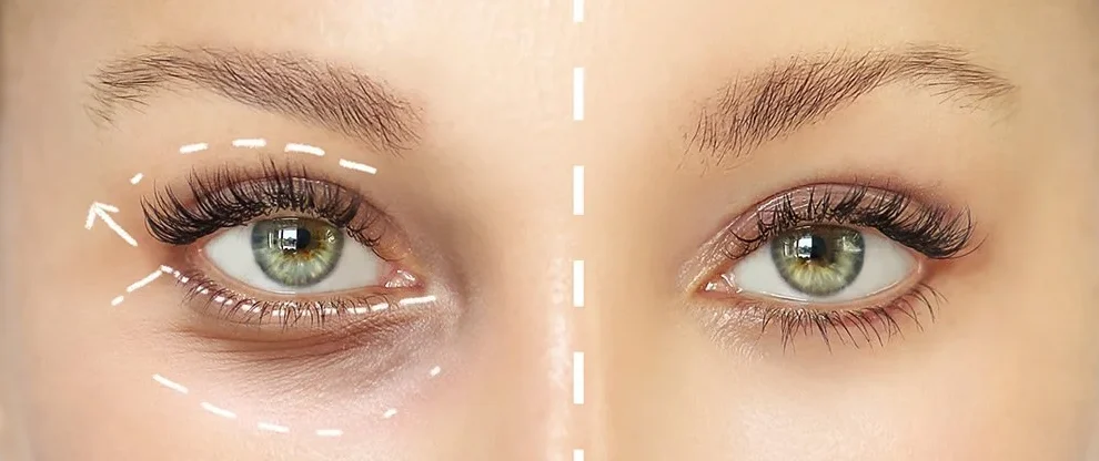 woman's eyes detailing how eyelid surgery can change the shape of her eye