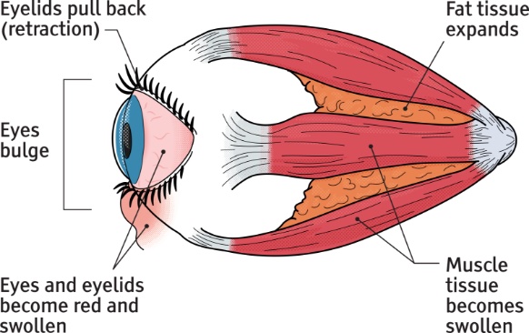 acute phase of thyroid eye disease diagram