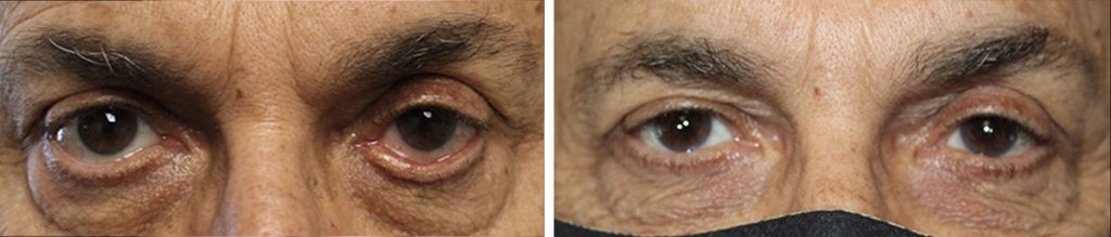 Ectropion Repair Before and After