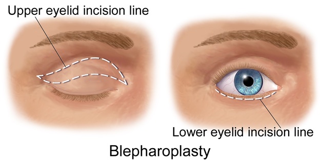 upper and lower eyelid incision lines for blepharoplasty