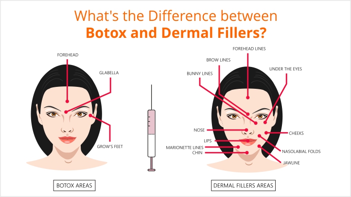 Diagram shows the different areas that can be targeted with botox injectables and dermal fillers