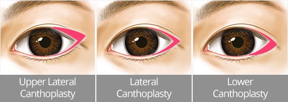 upper, lateral, and lower canthoplasty difference image