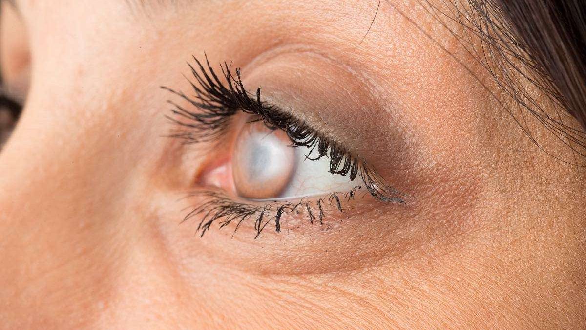 Woman's eye cloudy with cataract