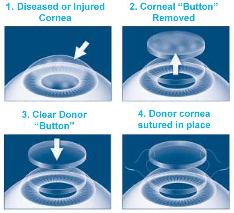 Diagram illustrating the steps of cornea transplant surgery