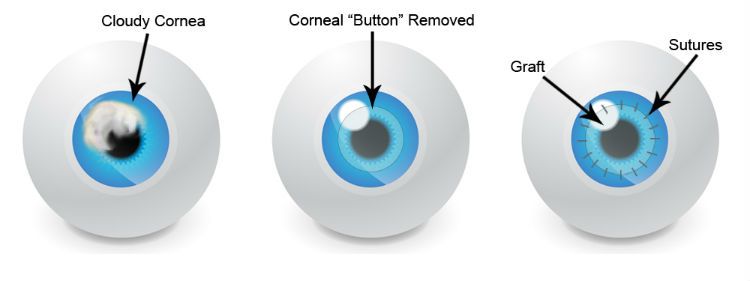 Diagram outlining the steps of cornea transplant surgery