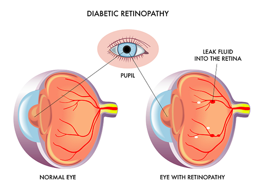 Diagram comparing normal eye to an eye with diabetic retinopathy