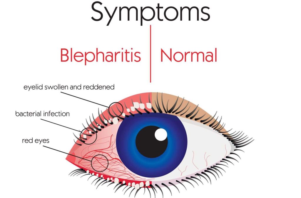 Illustration showing the symptoms of blepharitis