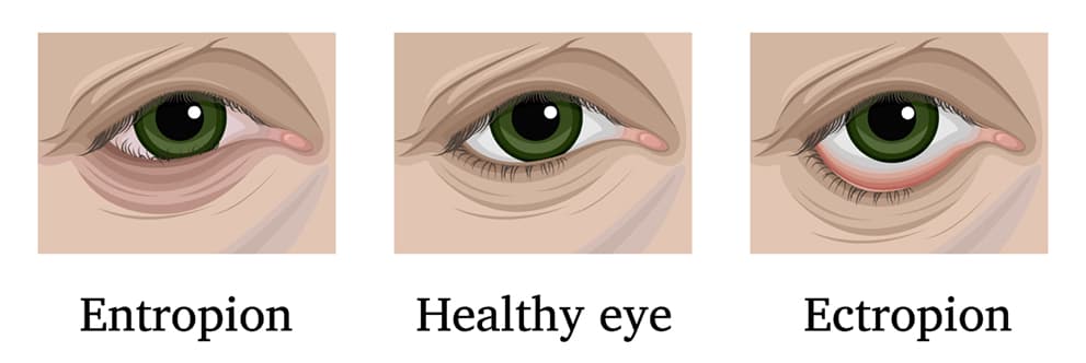 Entropion, healthy eye, and ectropion comparison