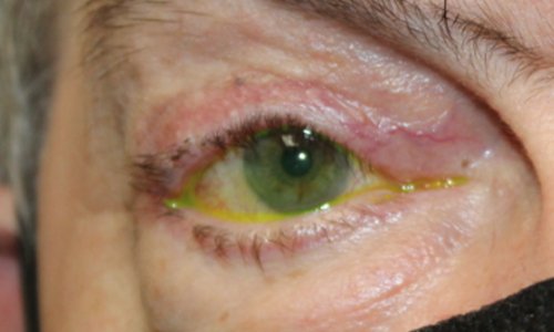close up of mans eye after entropion and eyelid retraction