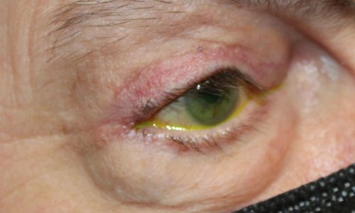 eye close up after entropion eyelid repair