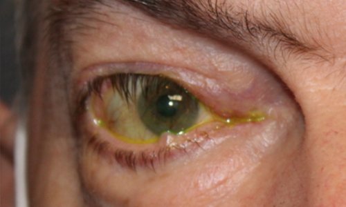 mans eye before entropion and eyelid retraction