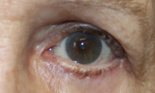 close up of male eye after entropion repair